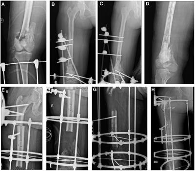 Bone transport combined with sequential nailing technique for the management of large segmental bone defects after trauma